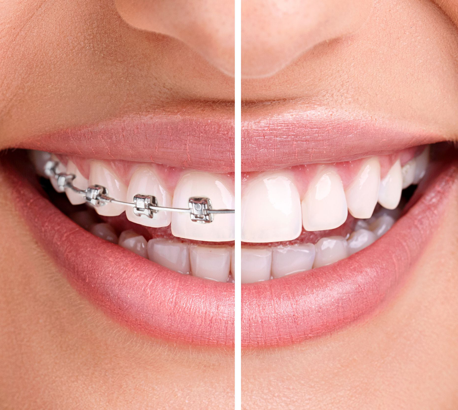 1057-dudley-smiles-ortho-braces-issaquah-invisalign-kent.png