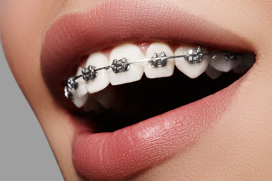 1057-metal-braces-are-an-ideal-solution-for-straightening-crooked-teeth.jpg