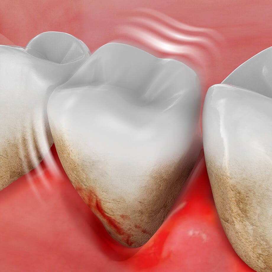 1740-agd-symptoms-toothloss.jpg