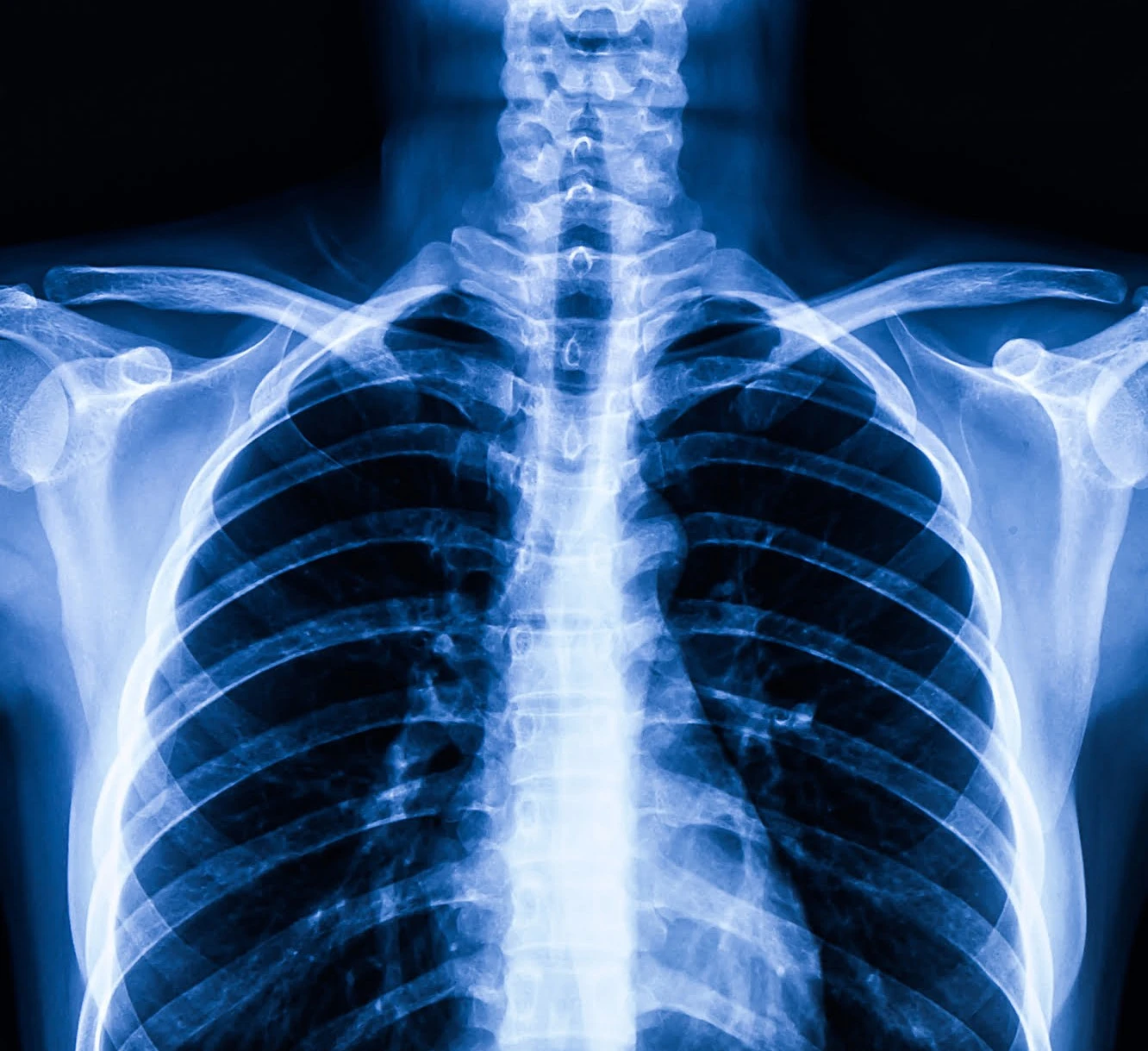 022133212191247-factores-del-cancer-de-torax-17865787378073.jpg
