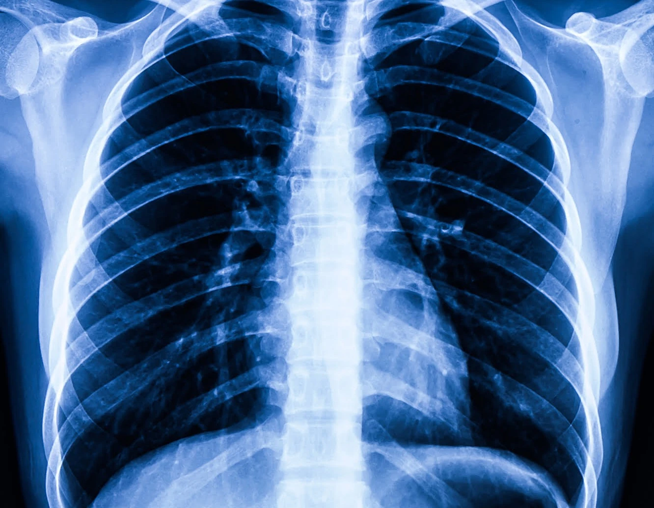 0390133210341359-factores-del-cancer-de-torax-17865787378073.jpg