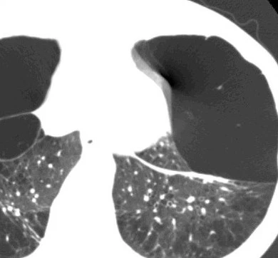 20293903621297-alpha1-antitrypsinedeficiencylungctscan-17865820061709.jpeg