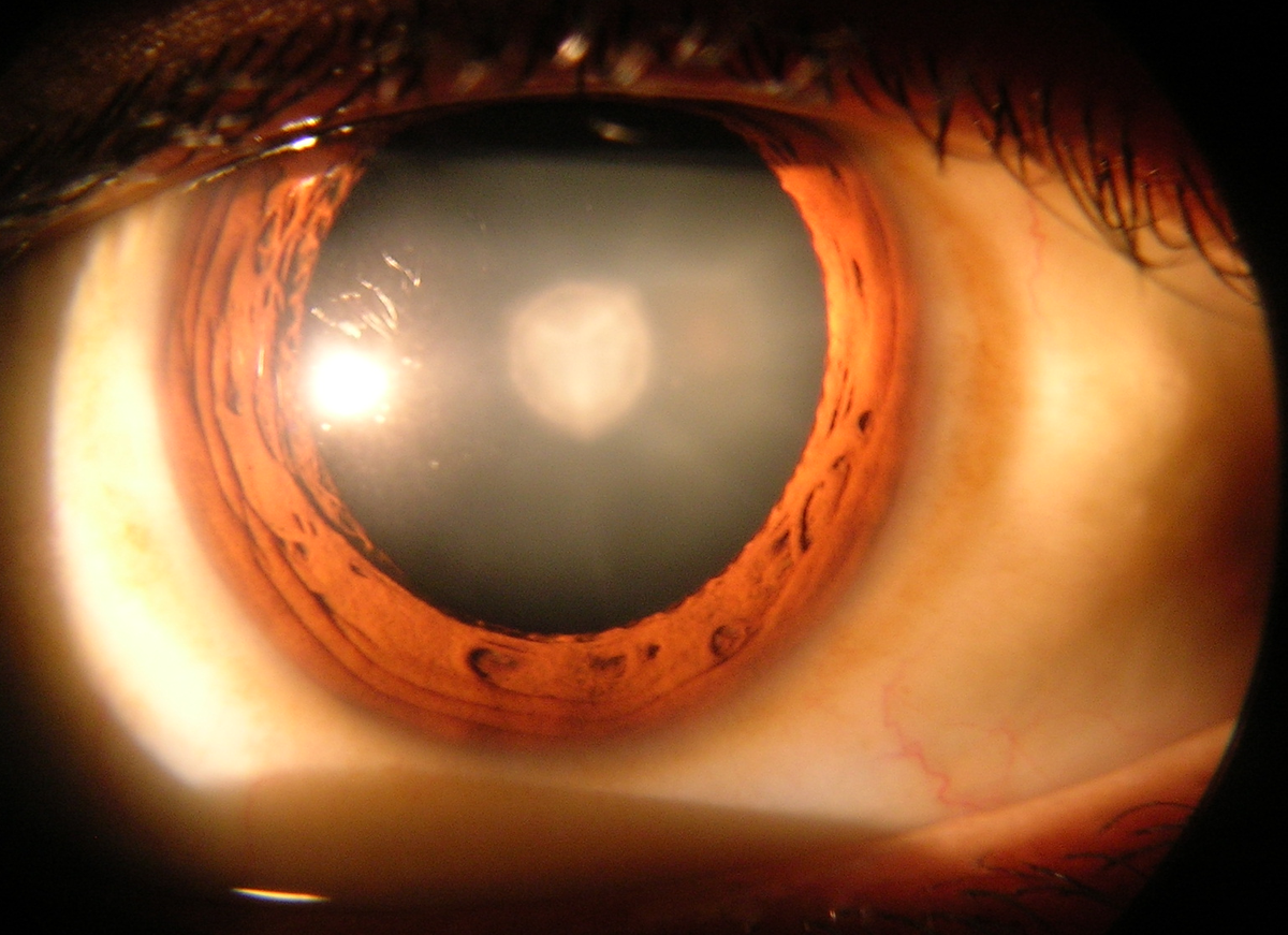 44-cataract-image.png