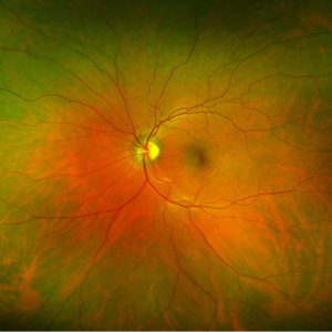 46-retina-image.jpg
