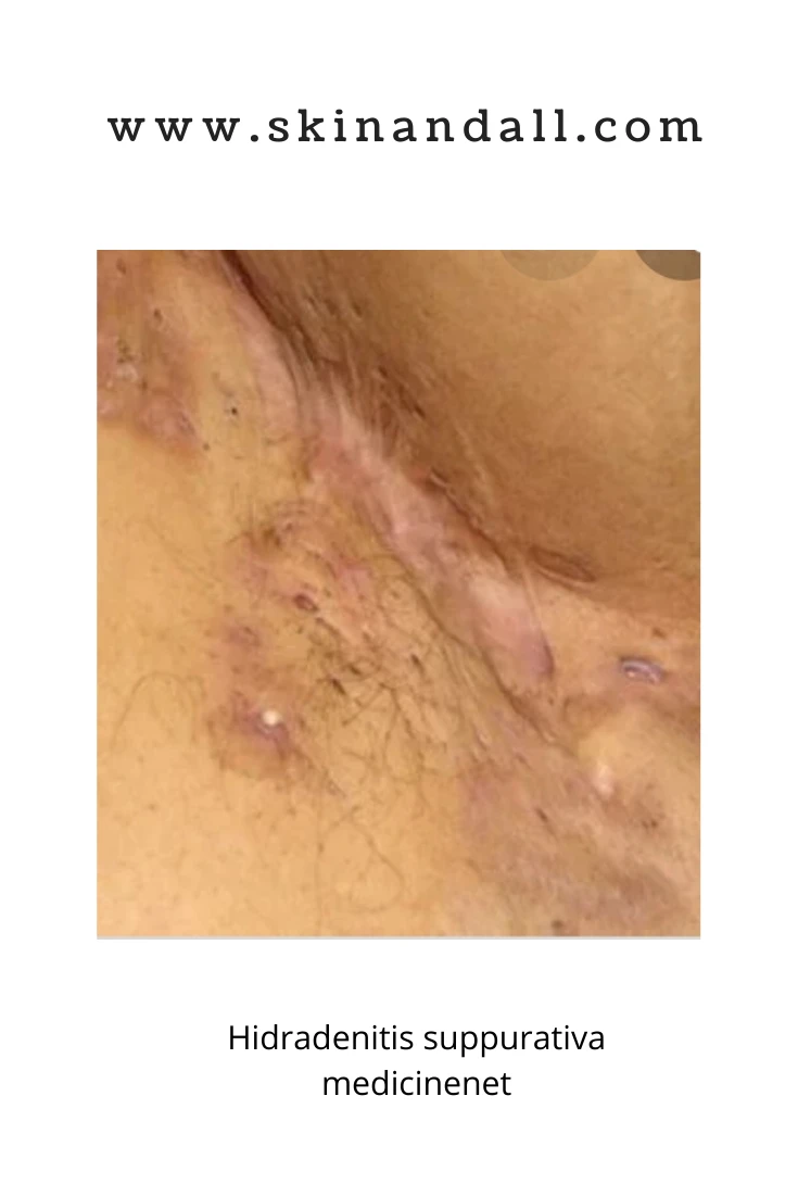 Hidradenitis suppurativa aka Acne inversa