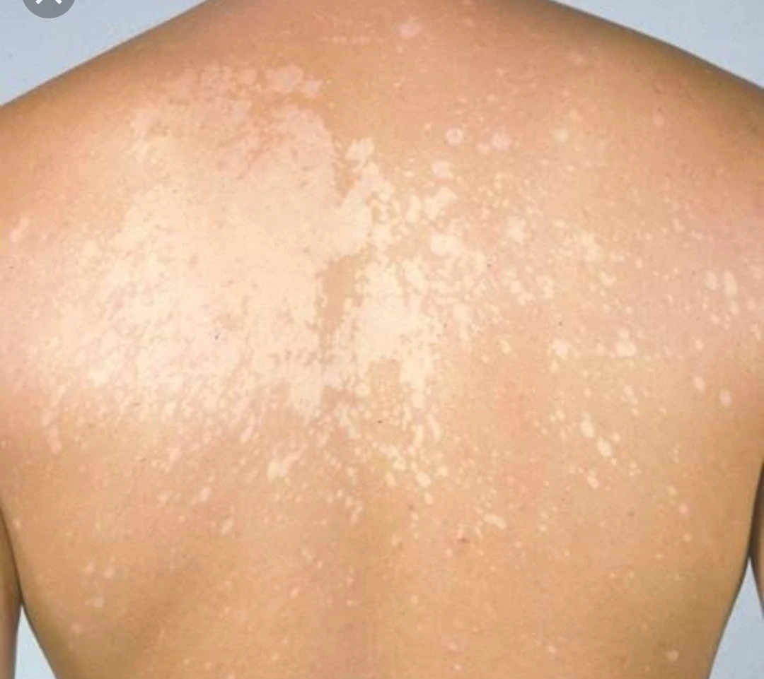 What eczema is not…and what it is.