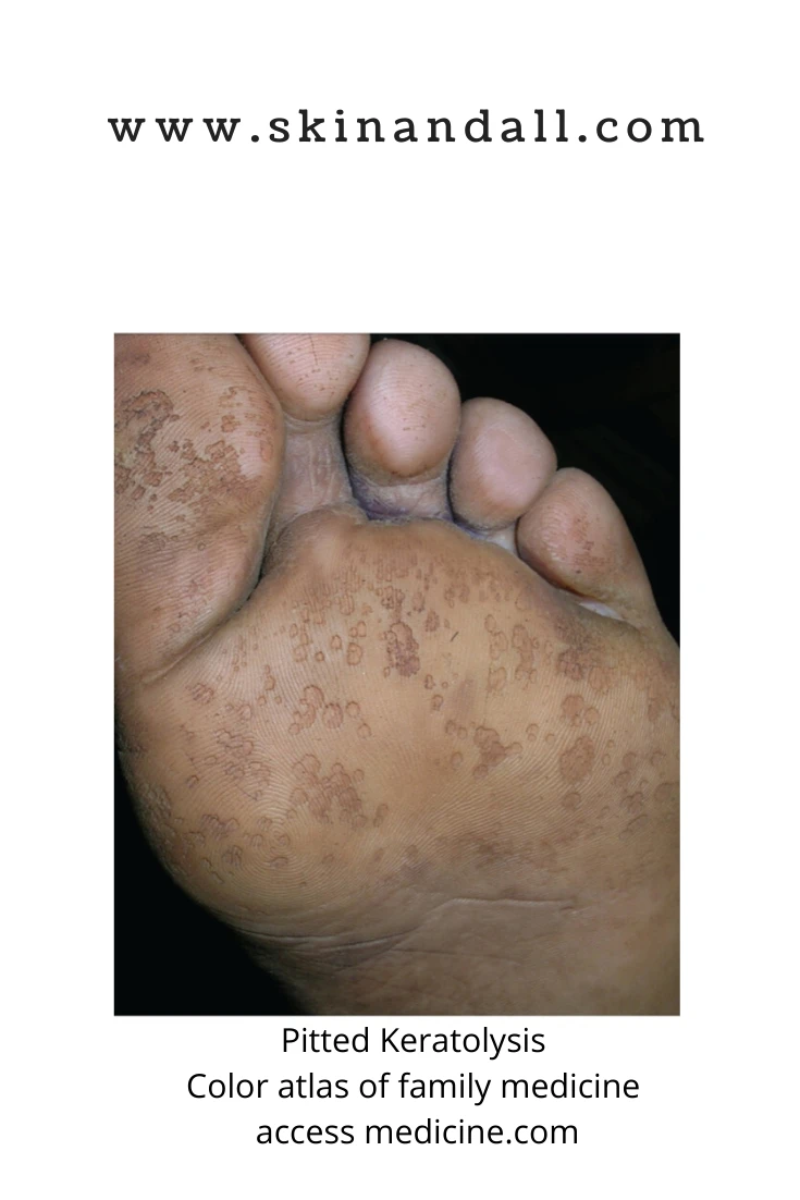 The smelly feet