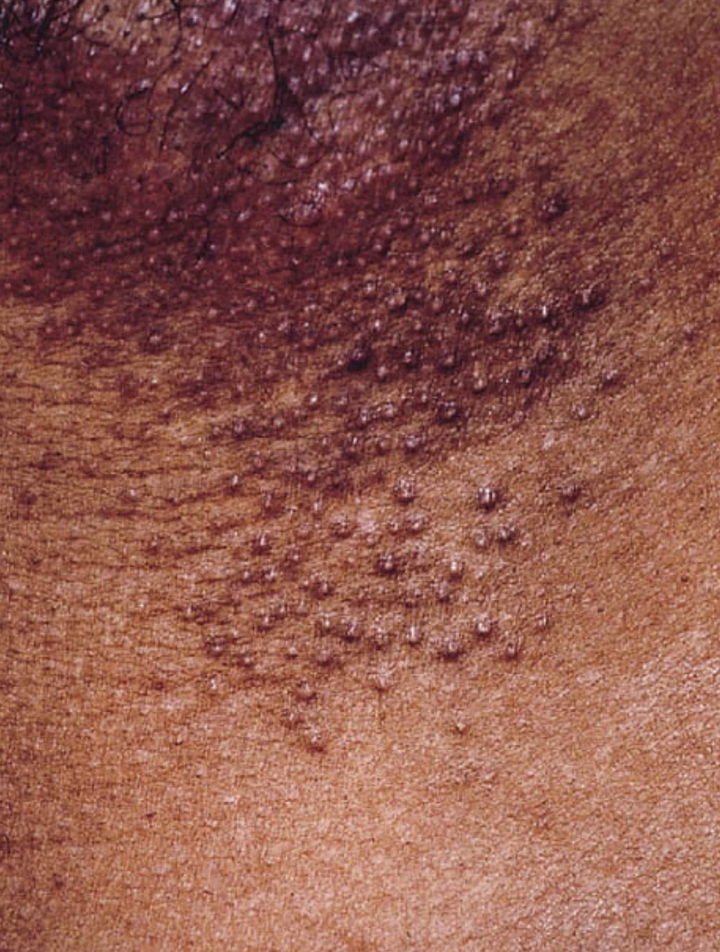 Chronic itching in the armpits and groin?