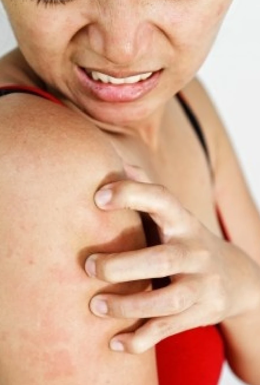 Itching especially after bathing?