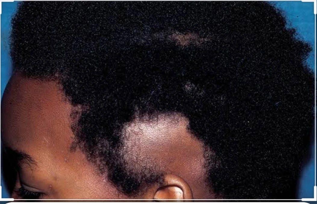 Let’s talk about alopecia areata