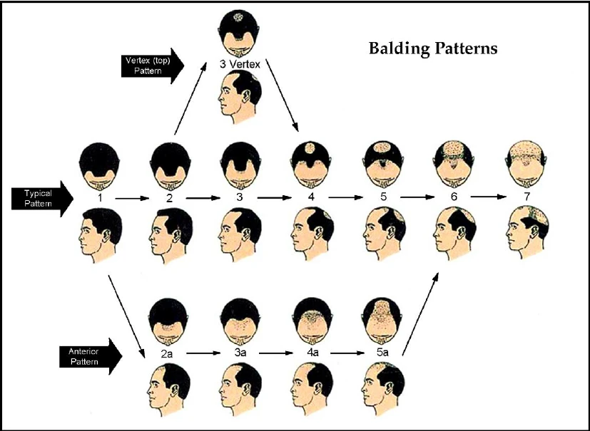 That common cause of hair loss -androgenetic alopecia