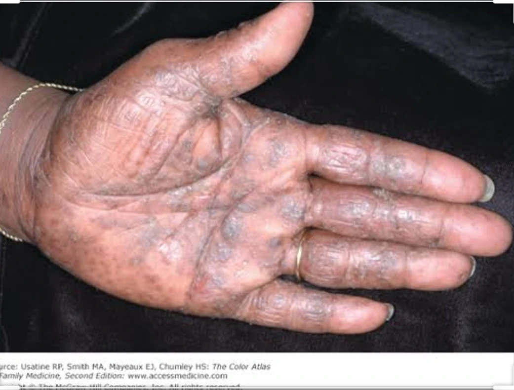 Let’s talk about hand dermatitis