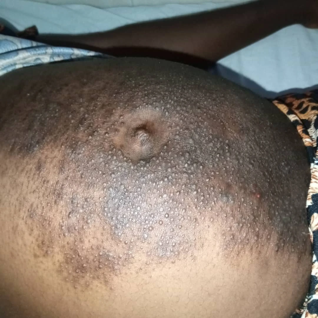 Let’s talk pregnancy induced dermatoses