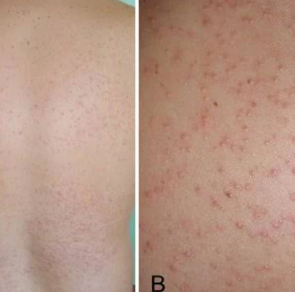 Not all that looks like acne is indeed acne