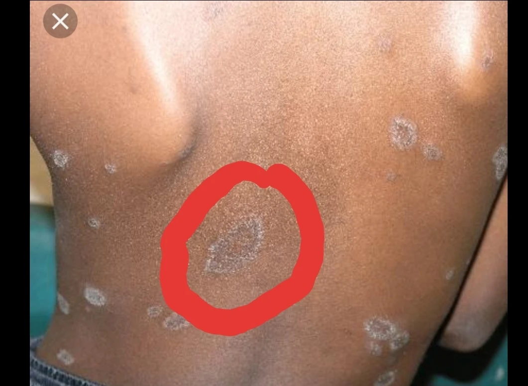 Let’s talk about pityriasis rosea