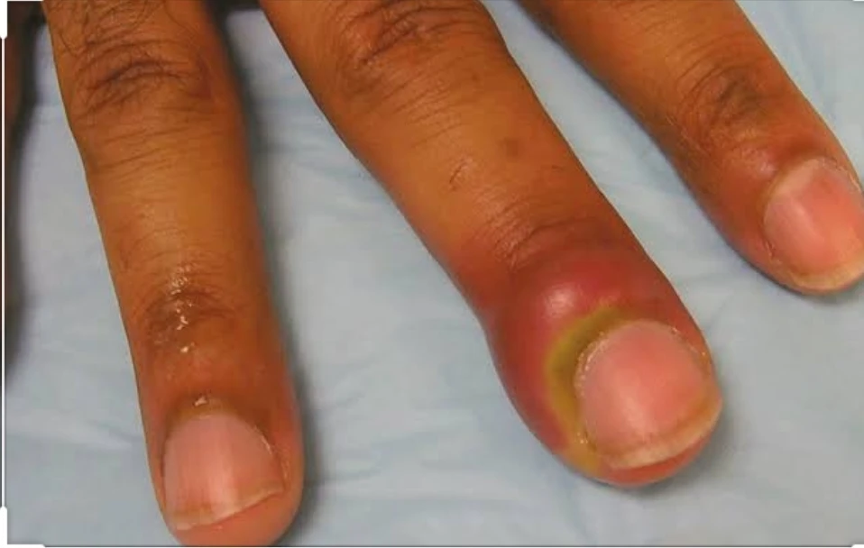 Let’s talk paronychia