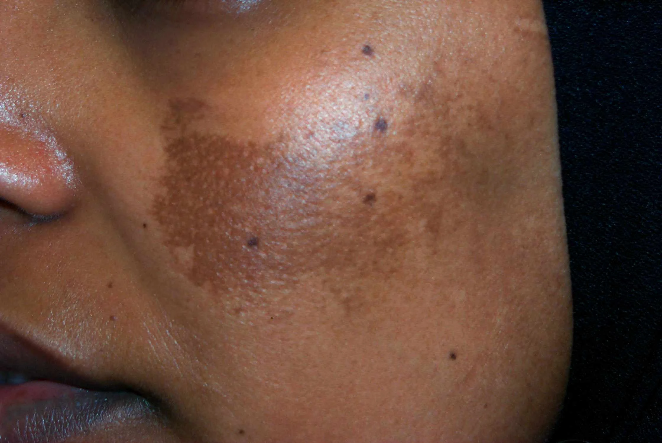 Melasma…that annoying hyperpigmentation that doesn’t seem to go away