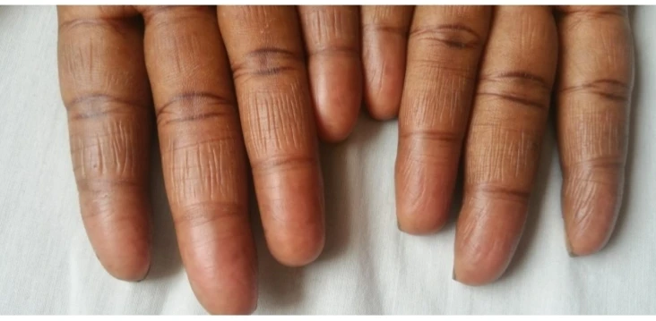 Adermatoglyphia aka Immigration delay disease