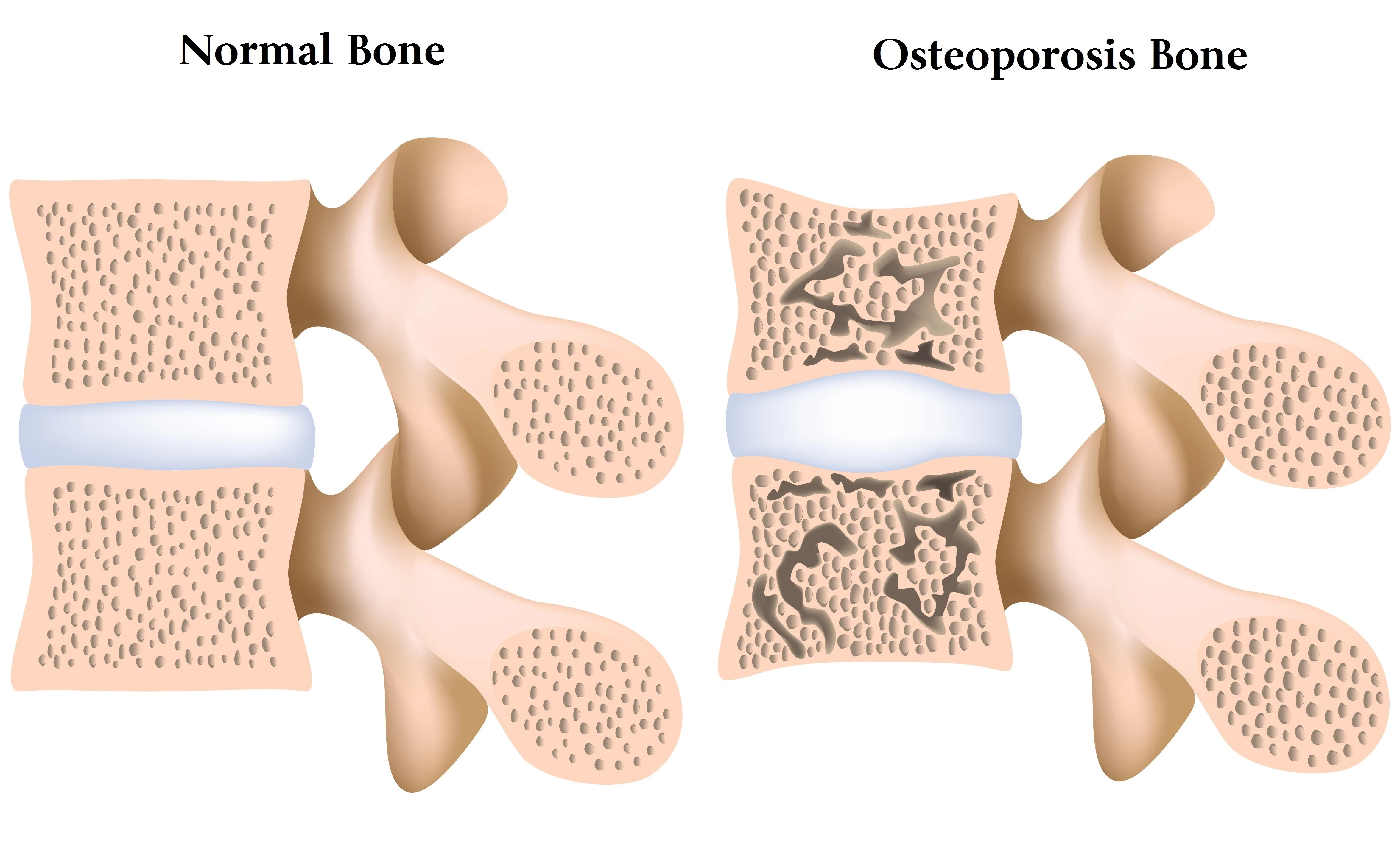0156470128412521-osteoporosis-bone-vs-normal-bone.jpg