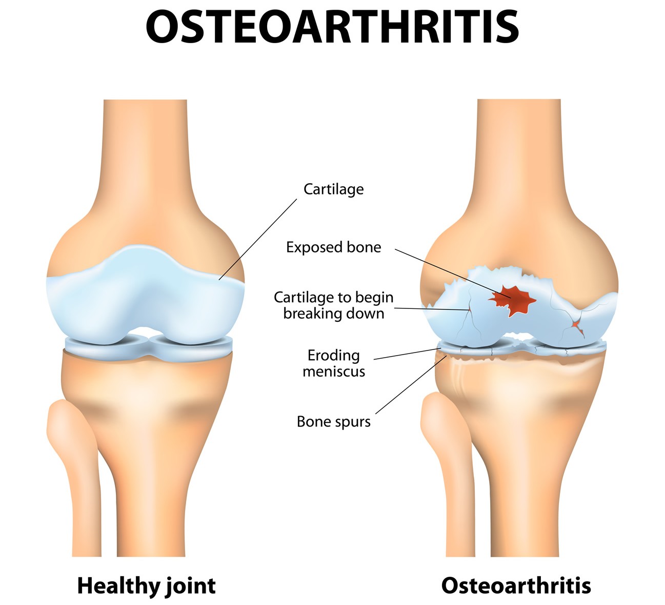 05912971179925-osteoarthritis.jpg
