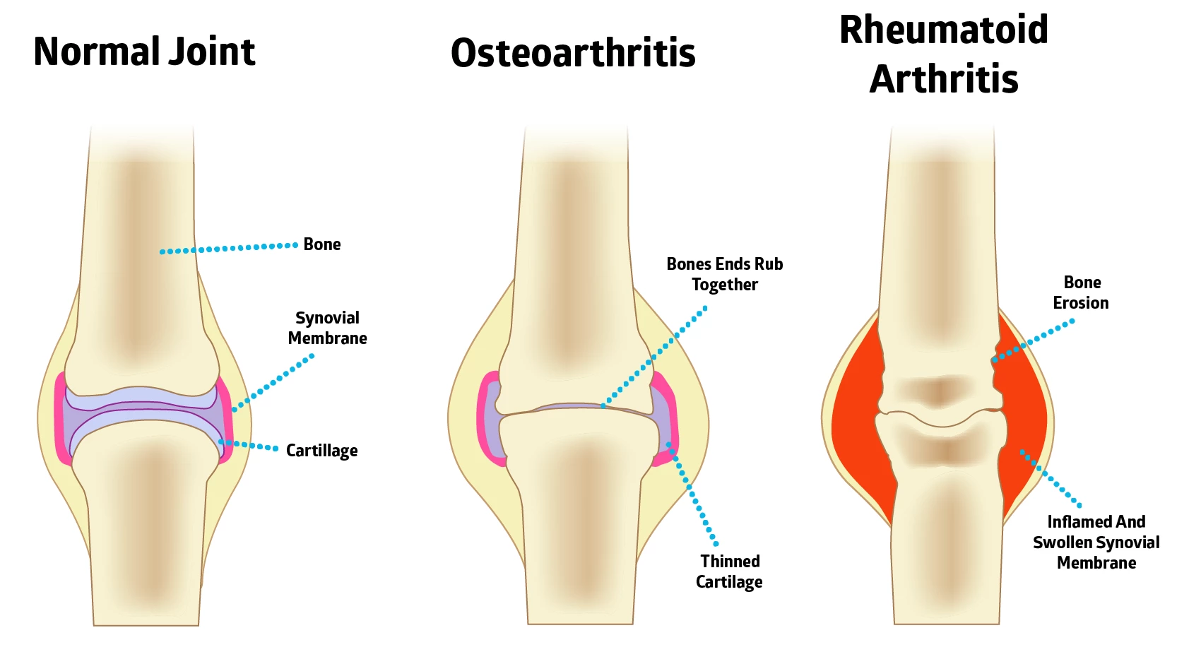 07317009232596-osteoarthritis-vs-rheumatoid-arthritis-15668039987761.png