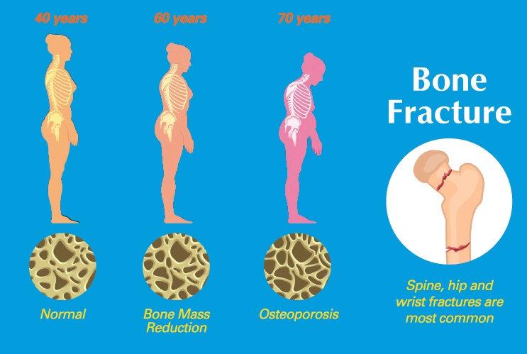 1485-stages-of-osteoporosis.jpg