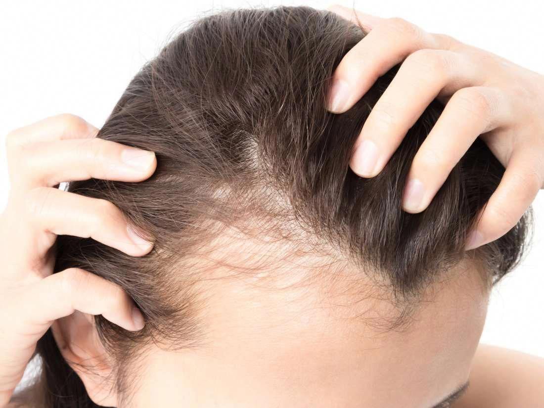 3735-1133-hair-loss.jpg