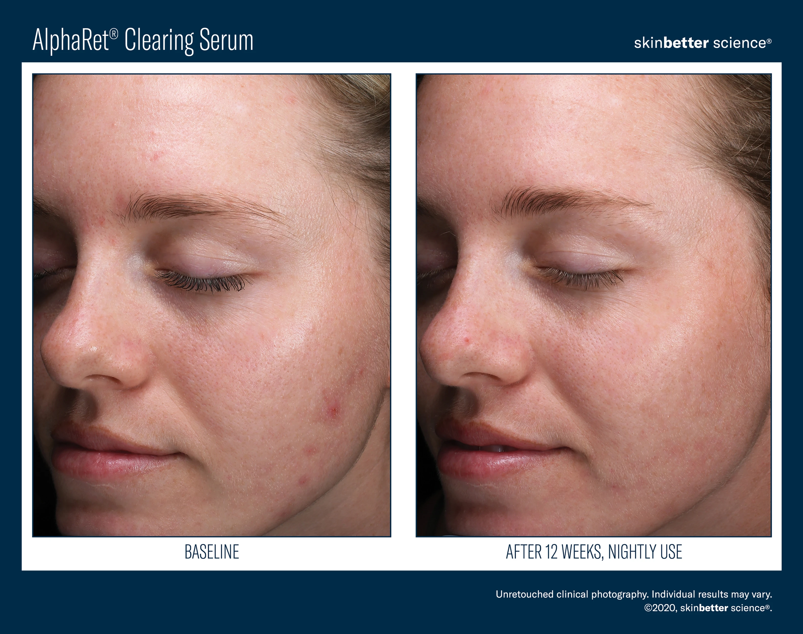 478-alpharet-clearing-serum-before-after-template2020hqp4-17186653121177.jpg