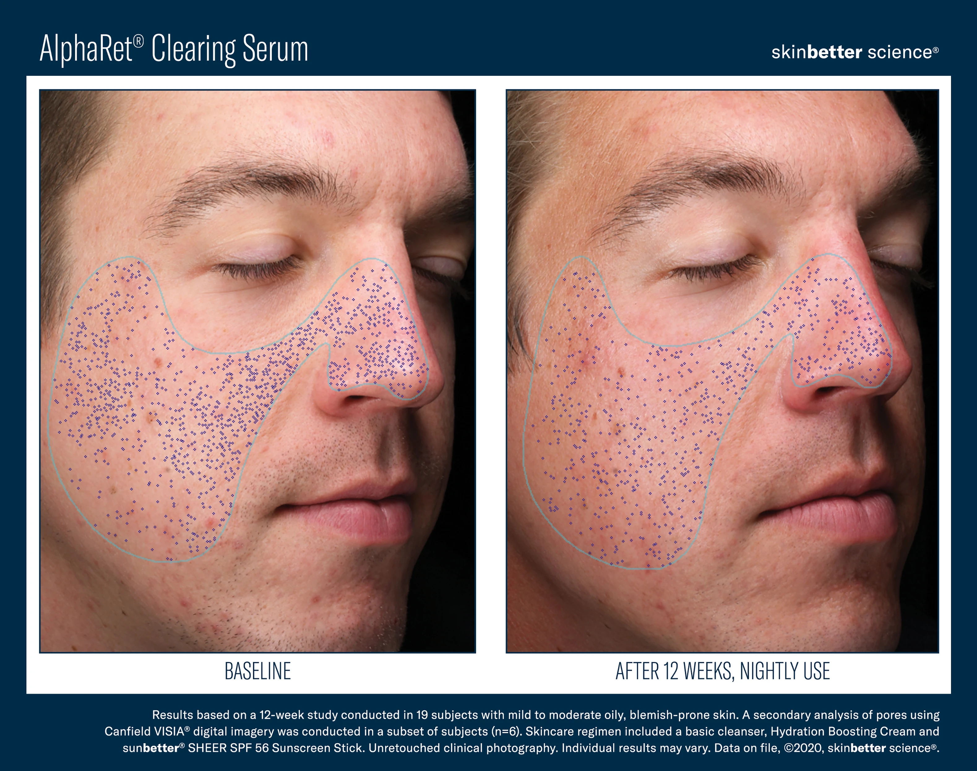 478-alpharet-clearing-serum-before-after-template2020hqp7-17186653176416.jpg